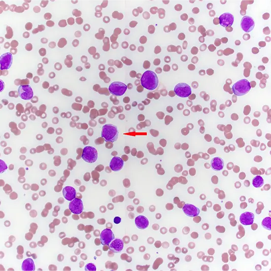 enhancer binding protein alpha (cebpa) mutation detection test